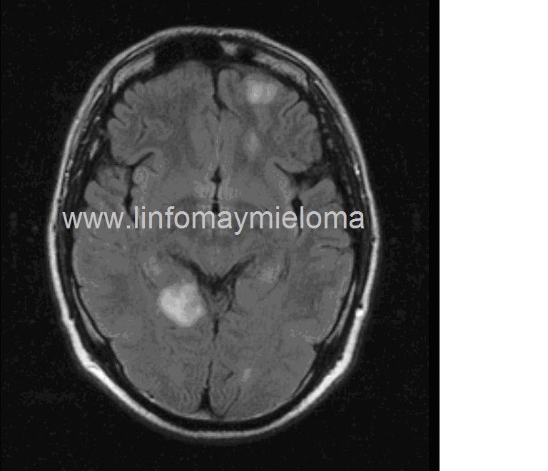 RNM craneal. Linfoma secundario